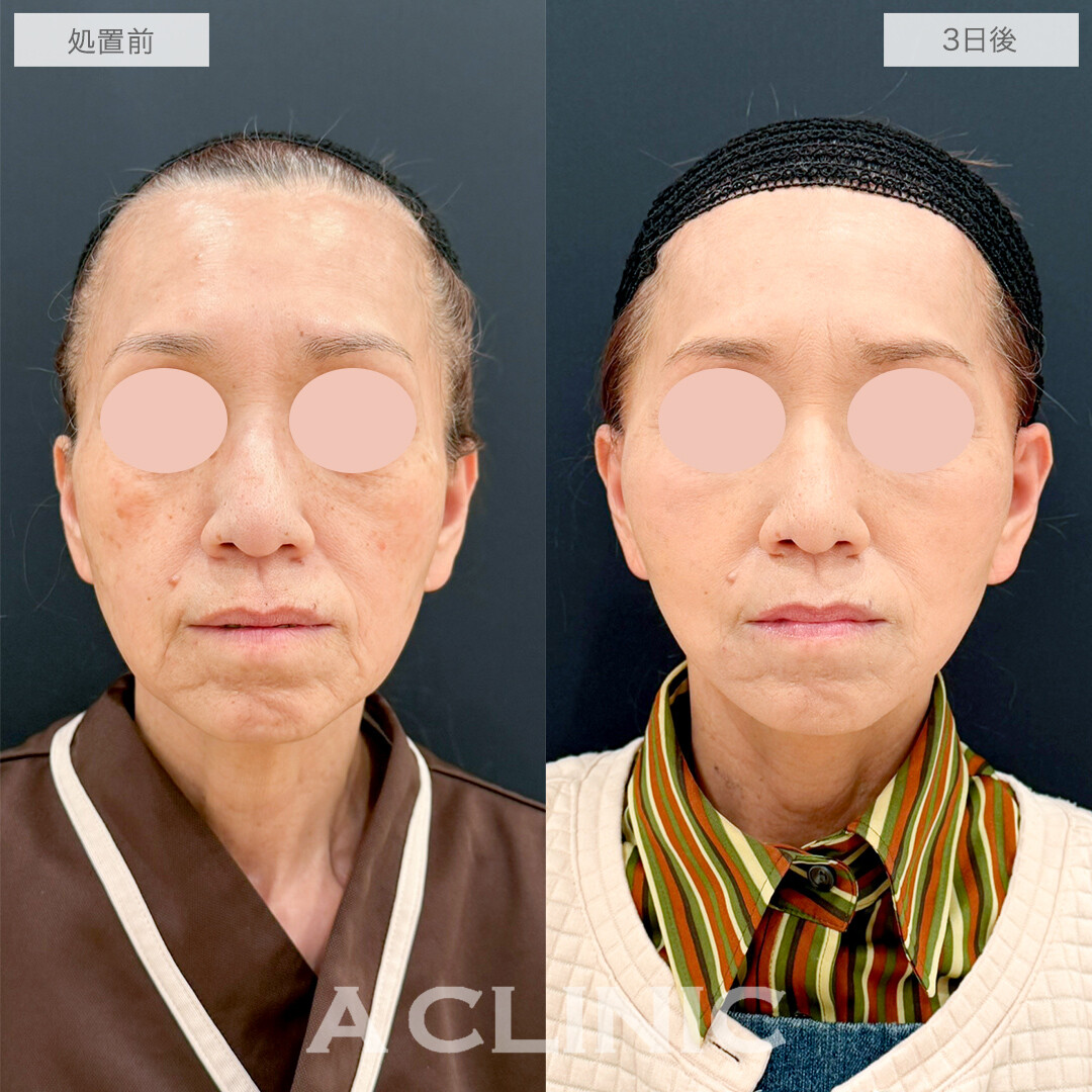 A式たるみ切開でお顔の重心が上がり若返り効果抜群！処置前と3日後の症例です(60代女性)