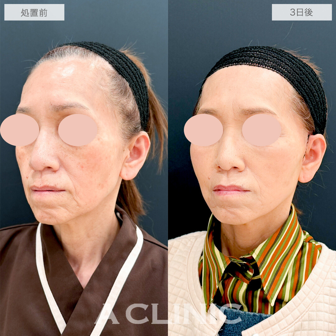 A式たるみ切開でお顔の重心が上がり若返り効果抜群！処置前と3日後の症例です(60代女性)