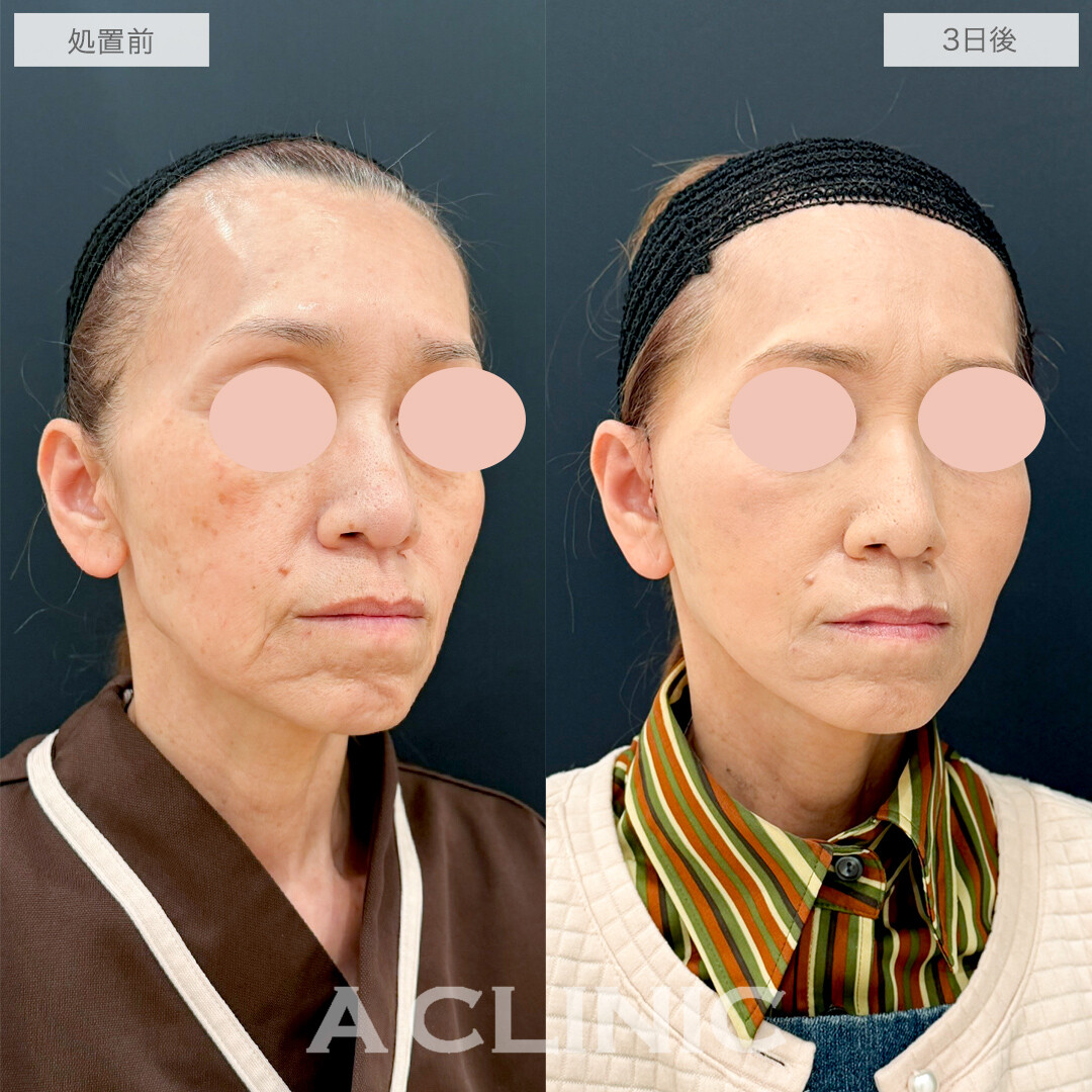 A式たるみ切開でお顔の重心が上がり若返り効果抜群！処置前と3日後の症例です(60代女性)