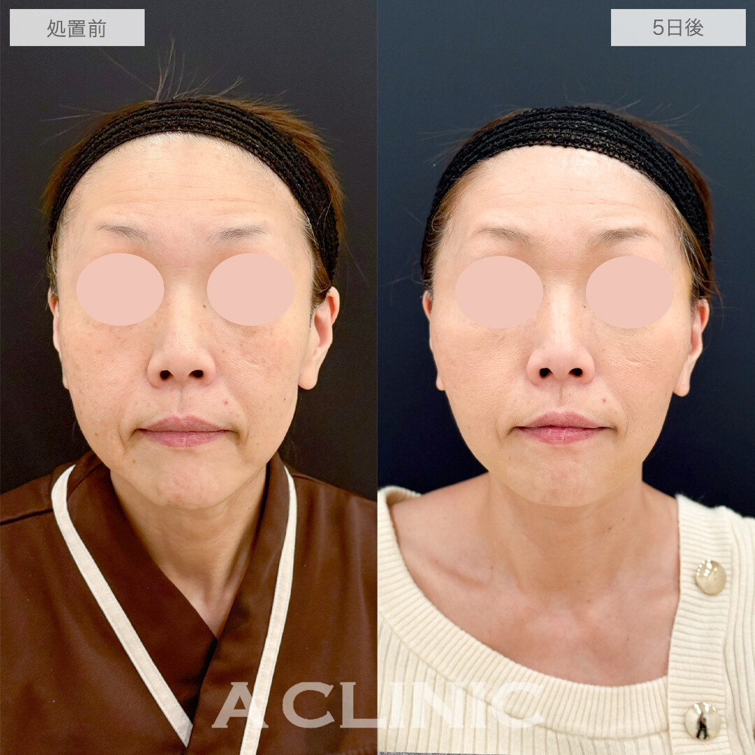 A式たるみ切開と1day小顔脂肪吸引で最短若返り！処置前と5日後の症例です(50代女性)