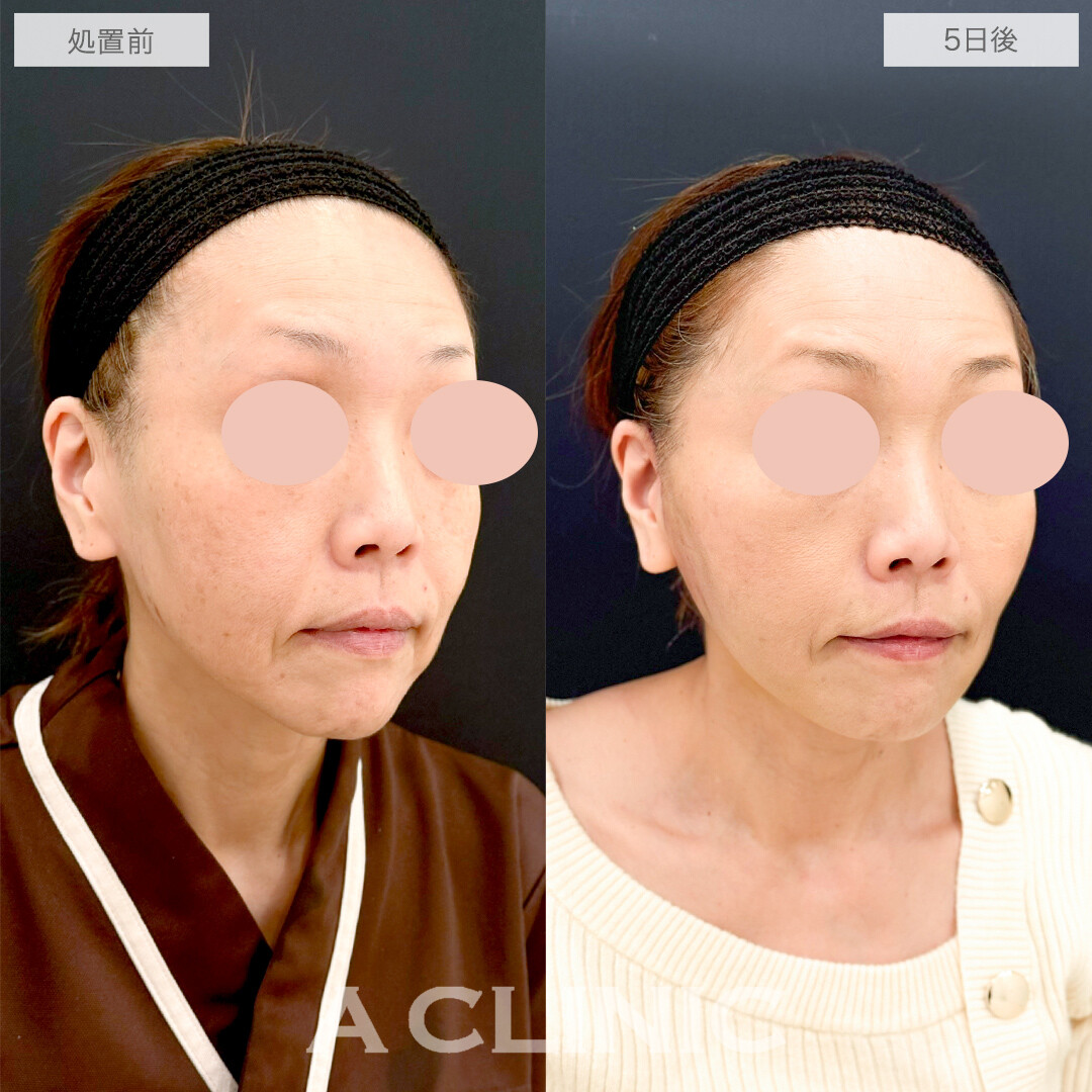 A式たるみ切開と1day小顔脂肪吸引で最短若返り！処置前と5日後の症例です(50代女性)