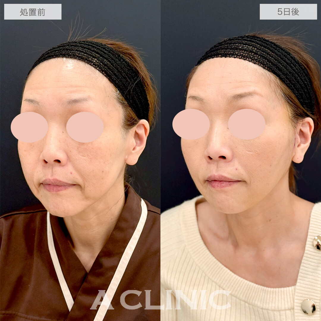 A式たるみ切開と1day小顔脂肪吸引で最短若返り！処置前と5日後の症例です(50代女性)
