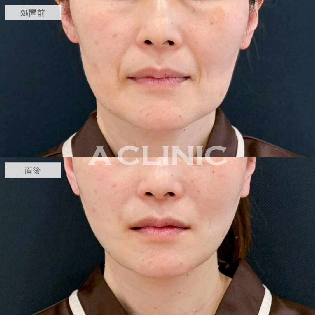 A式たるみ切開と1day小顔脂肪吸引で若々しい印象に変化しました！処置前と直後の症例です(50代女性)