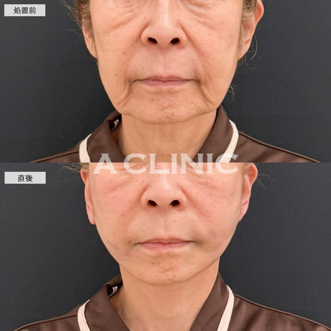 A式たるみ切開と1day小顔脂肪吸引で輪郭が若返り自信が持てるように！こちら処置前と直後の症例です(70代女性)