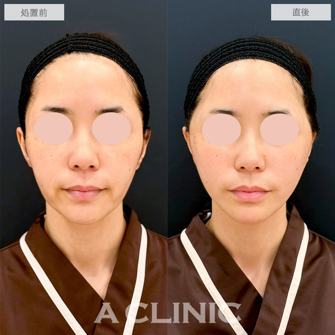 A式たるみ切開で口横のもたつきがスッキリ！処置前と直後の症例です(40代女性)