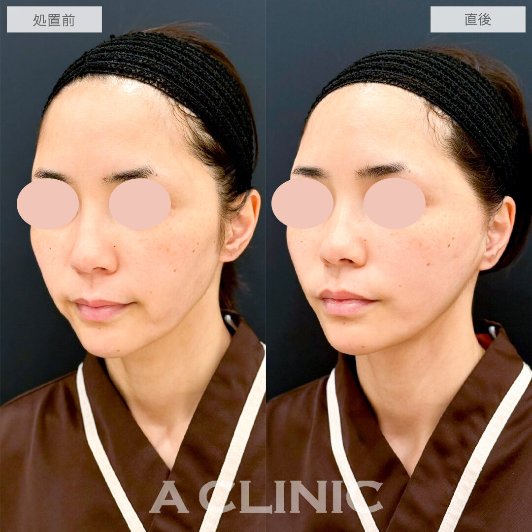 A式たるみ切開で口横のもたつきがスッキリ！処置前と直後の症例です(40代女性)