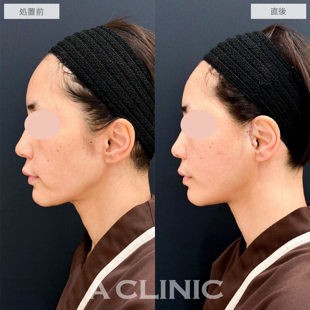 A式たるみ切開で口横のもたつきがスッキリ！処置前と直後の症例です(40代女性)