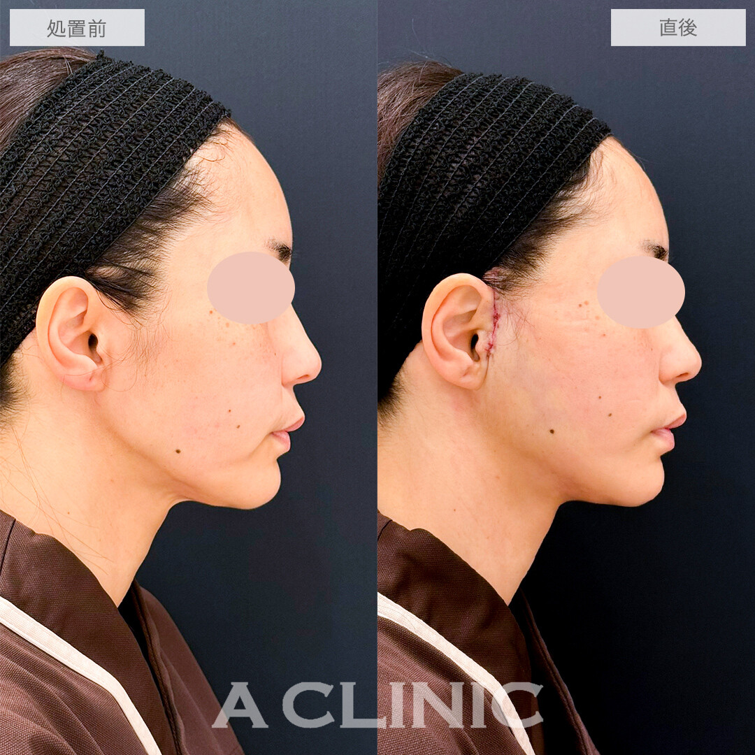 A式たるみ切開で口横のもたつきがスッキリ！処置前と直後の症例です(40代女性)
