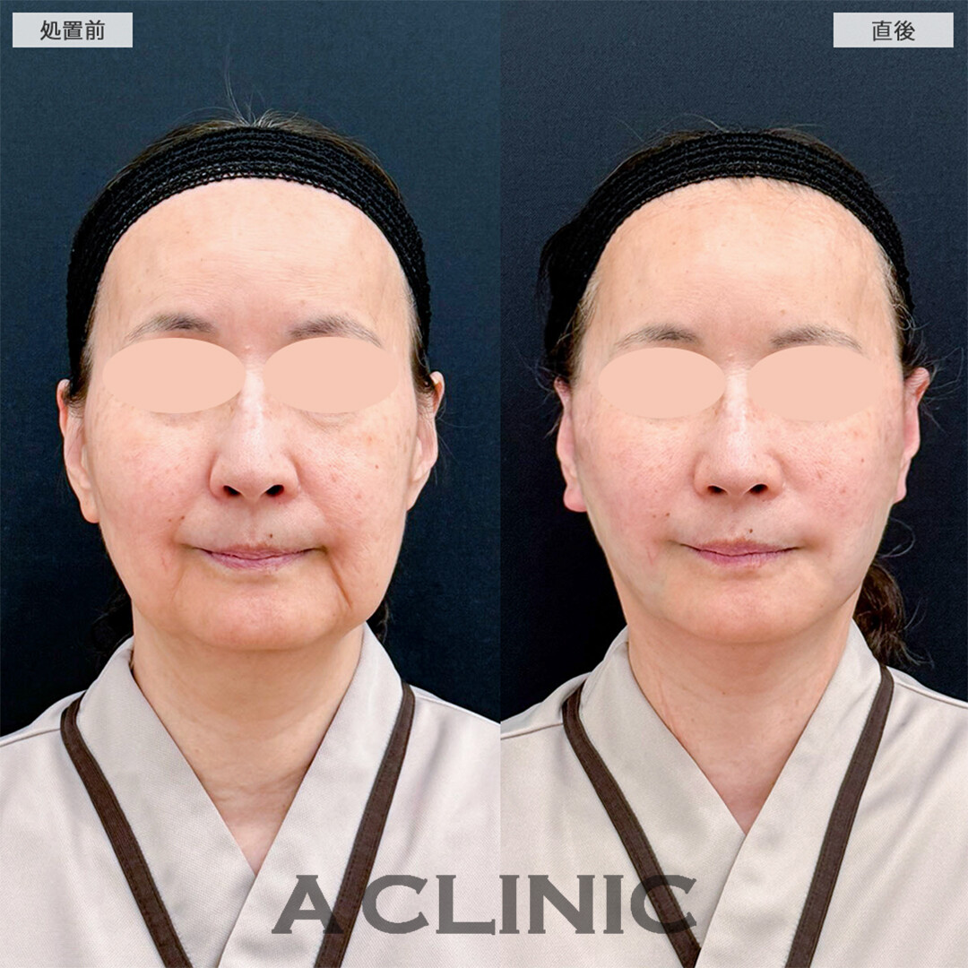 A式たるみ切開と1day小顔脂肪吸引は若返り最強施術です！こちら処置前と直後の症例です(50代女性)