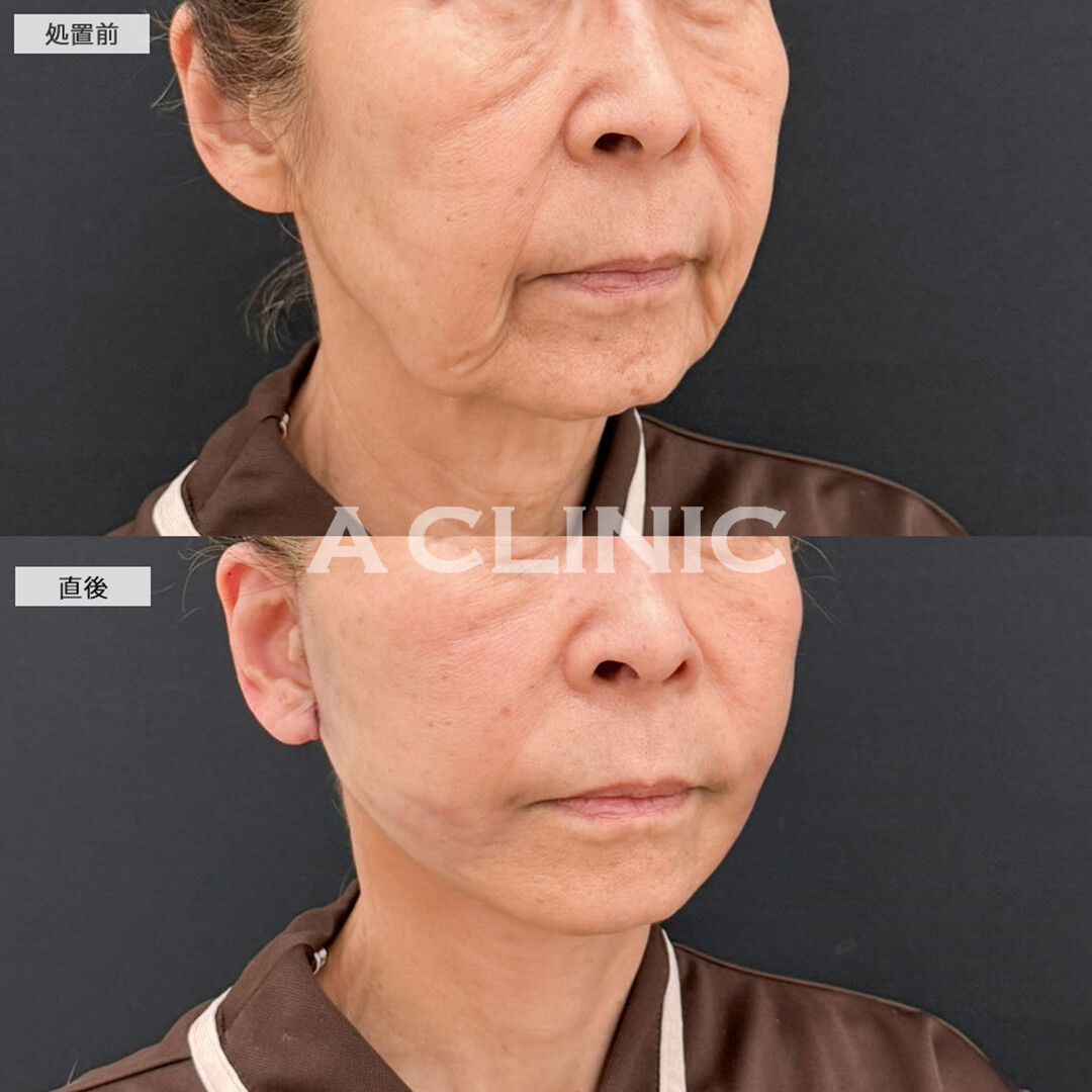 A式たるみ切開と1day小顔脂肪吸引で輪郭が若返り自信が持てるように！こちら処置前と直後の症例です(70代女性)