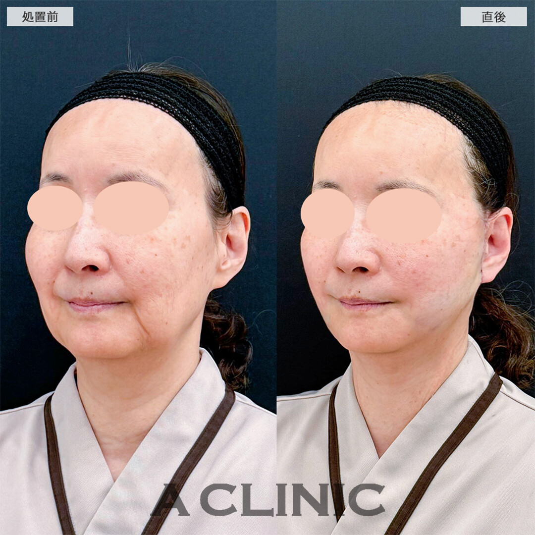 A式たるみ切開と1day小顔脂肪吸引は若返り最強施術です！こちら処置前と直後の症例です(50代女性)