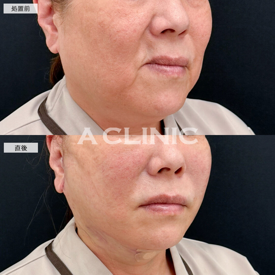 1day小顔脂肪吸引とA式たるみ切開なら直後から効果を実感できます！こちら処置前と直後の症例です(60代女性)