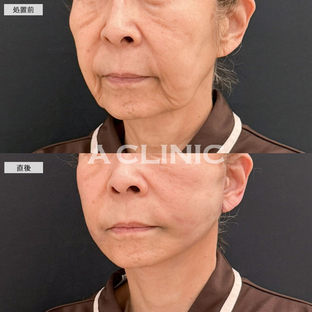 A式たるみ切開と1day小顔脂肪吸引で輪郭が若返り自信が持てるように！こちら処置前と直後の症例です(70代女性)