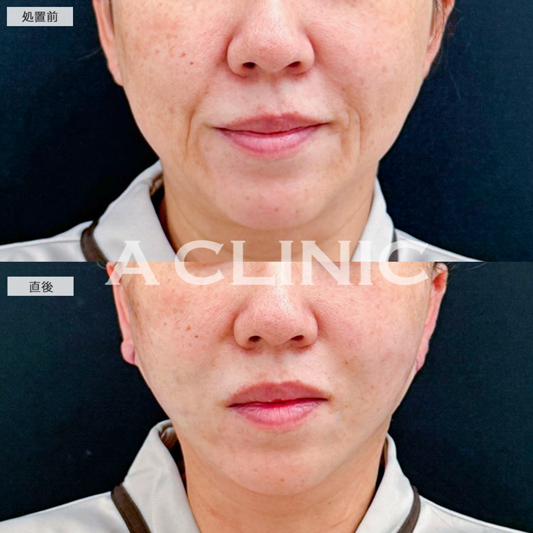 A式たるみ切開と1day小顔脂肪吸引で施術直後からほうれい線のない綺麗な輪郭になりました！こちら処置前と直後の症例です(40代女性)