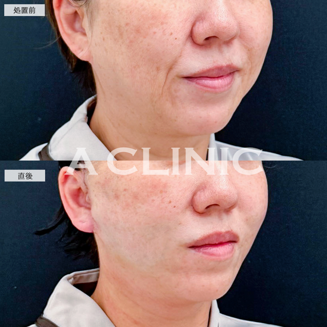 A式たるみ切開と1day小顔脂肪吸引で施術直後からほうれい線のない綺麗な輪郭になりました！こちら処置前と直後の症例です(40代女性)
