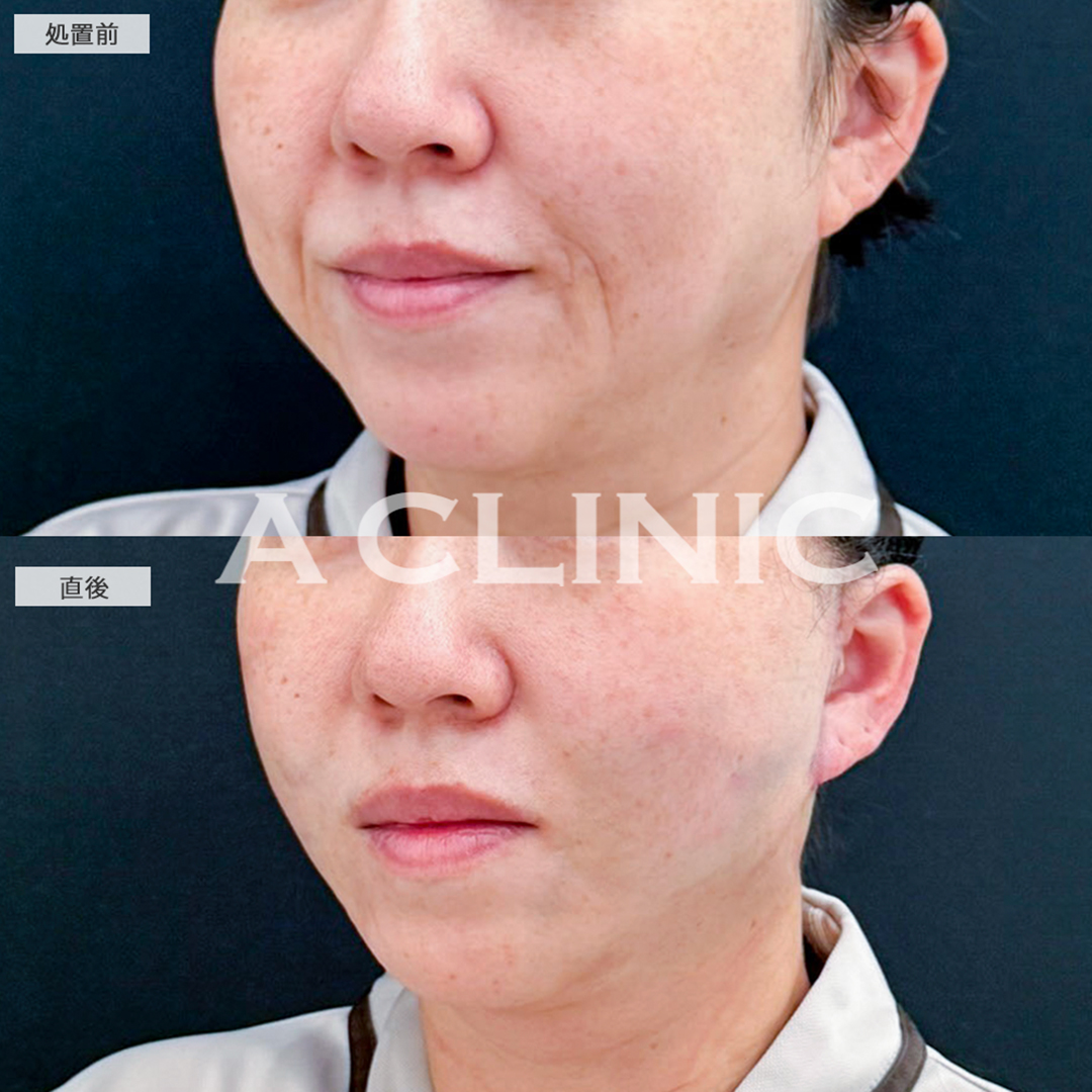 A式たるみ切開と1day小顔脂肪吸引で施術直後からほうれい線のない綺麗な輪郭になりました！こちら処置前と直後の症例です(40代女性)