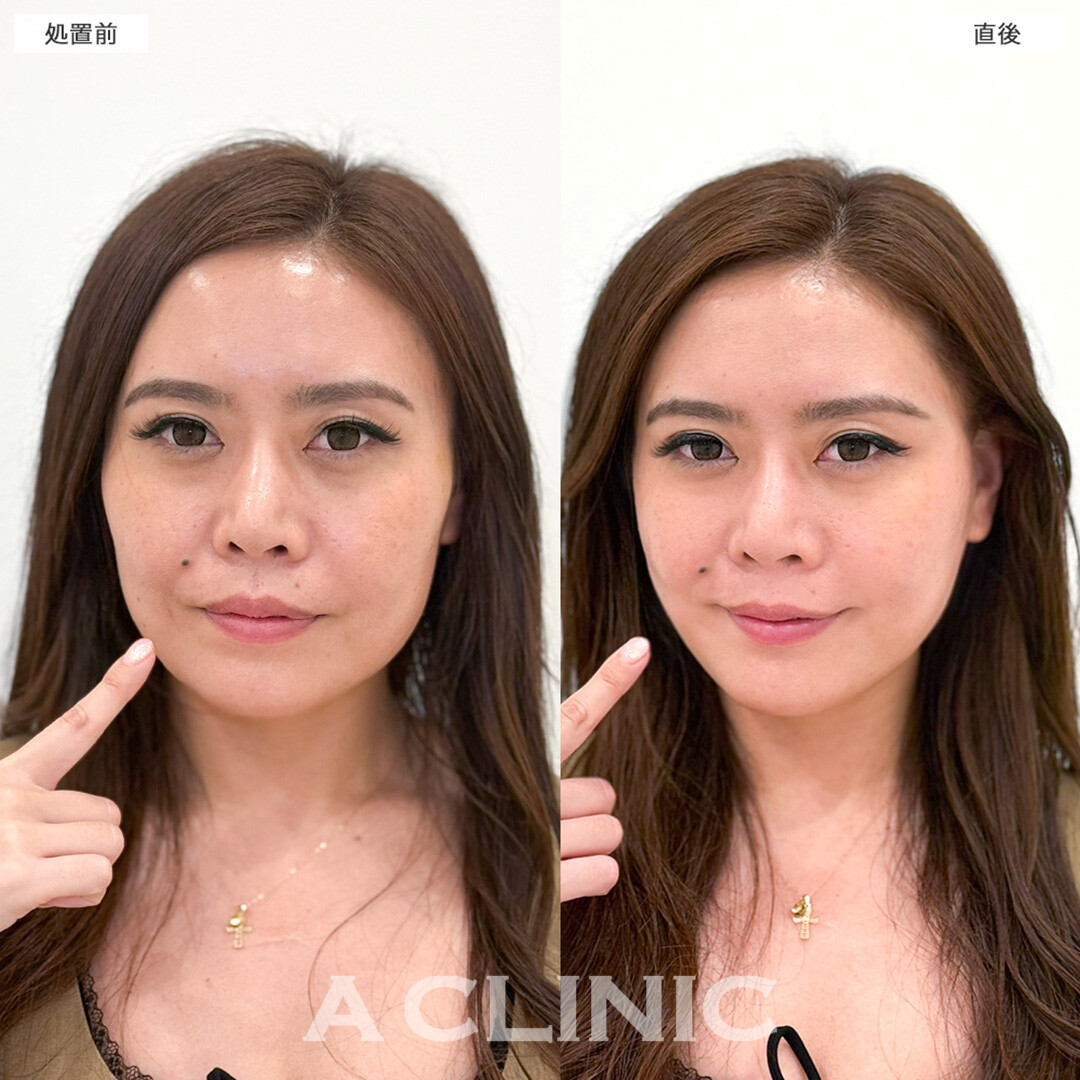 A式たるみ切開で持続するリフトアップを叶える！こちら処置前と直後の症例です(40代女性)