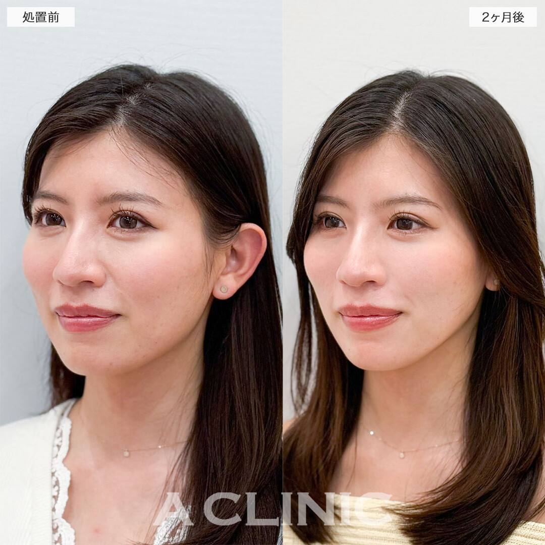 1day小顔脂肪吸引で余分な脂肪を除去し垢抜けに成功！こちら処置前と2ヶ月後の症例です(20代女性)