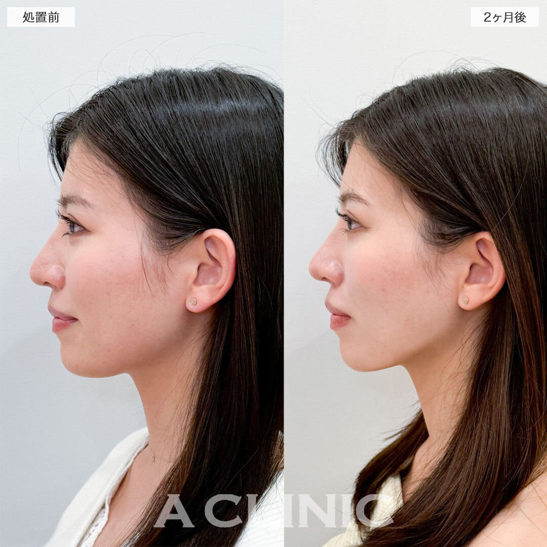1day小顔脂肪吸引で余分な脂肪を除去し垢抜けに成功！こちら処置前と2ヶ月後の症例です(20代女性)
