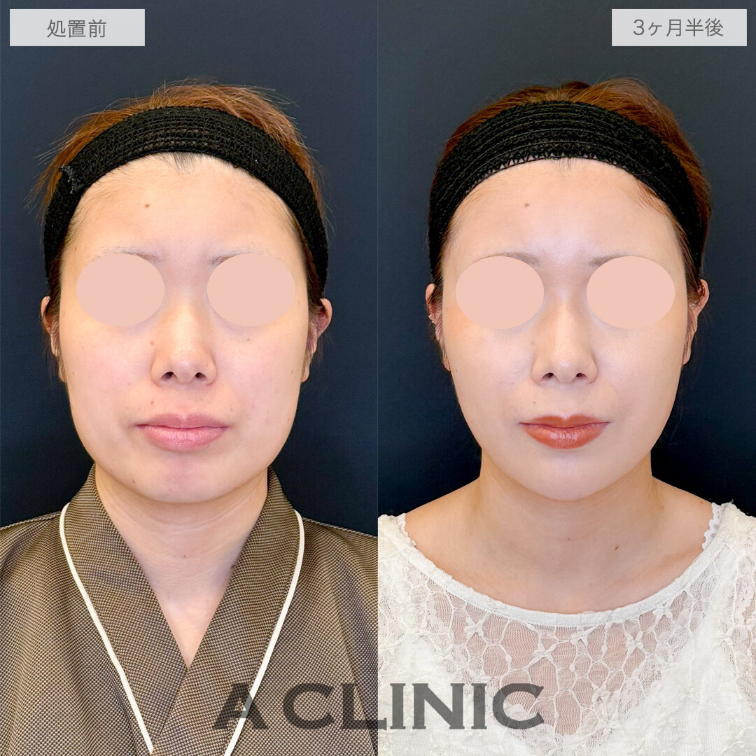 1day小顔脂肪吸引でつるんと可愛い卵型フェイスに！処置前と3ヶ月半後の症例です(20代女性)