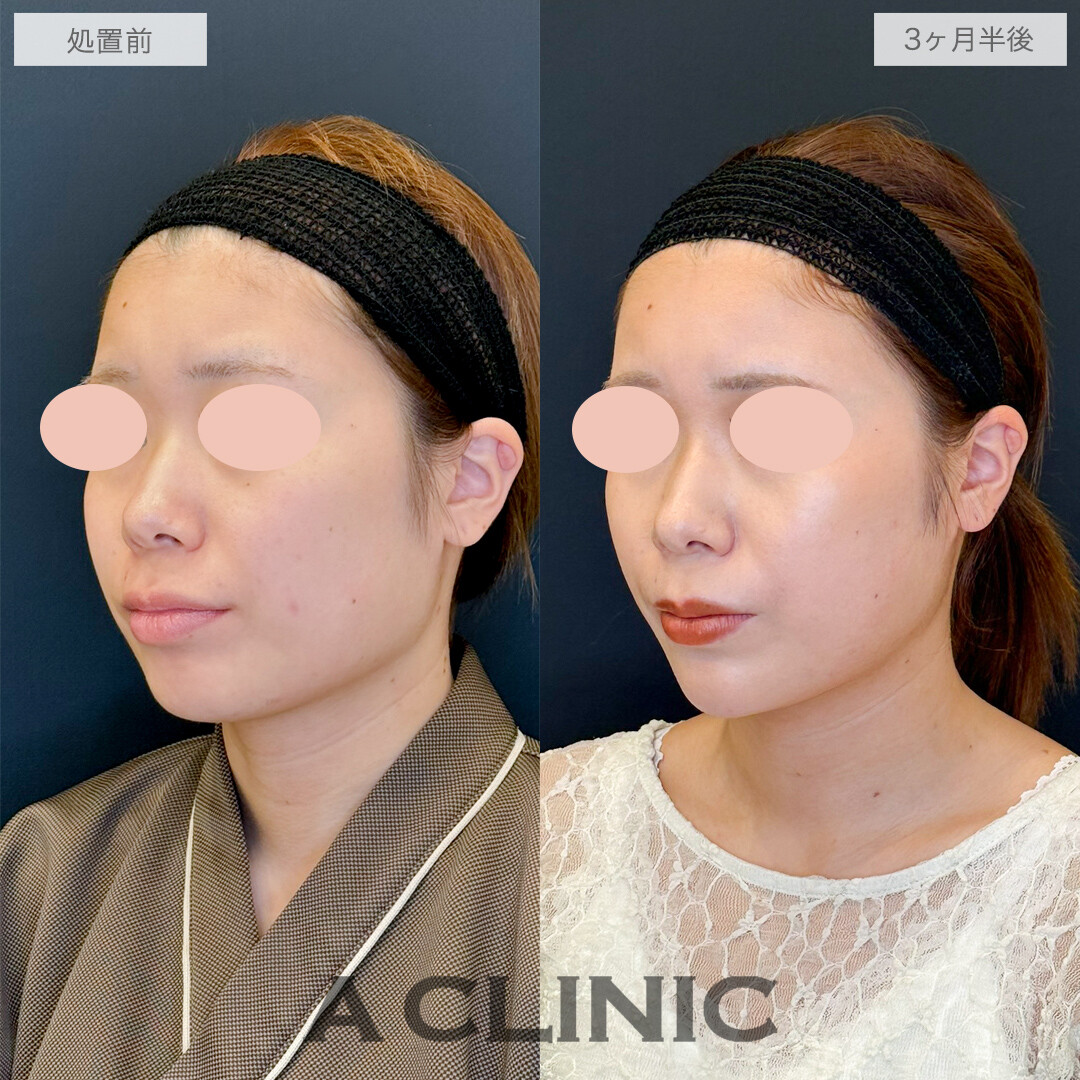 1day小顔脂肪吸引でつるんと可愛い卵型フェイスに！処置前と3ヶ月半後の症例です(20代女性)