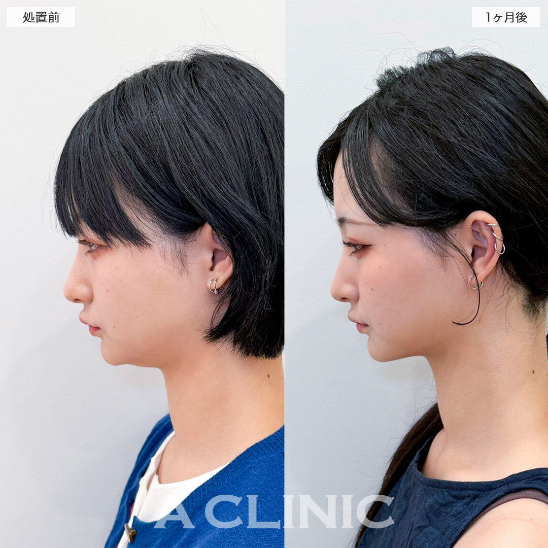 1day小顔脂肪吸引で周りから小顔をさらに褒められるようになりました！処置前と2ヶ月後の症例です(20代女性)