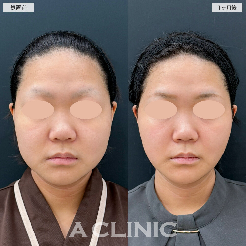 1day小顔脂肪吸引と小顔エラボトックスで輪郭がここまでスッキリ！処置前と1ヶ月後の症例です(20代女性)