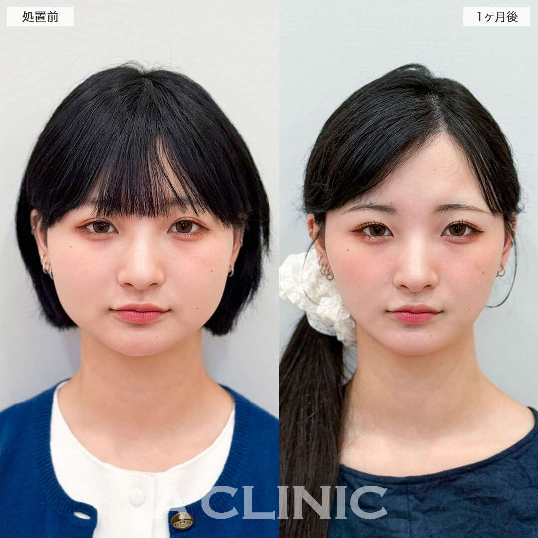 1day小顔脂肪吸引で周りから小顔をさらに褒められるようになりました！処置前と2ヶ月後の症例です(20代女性)