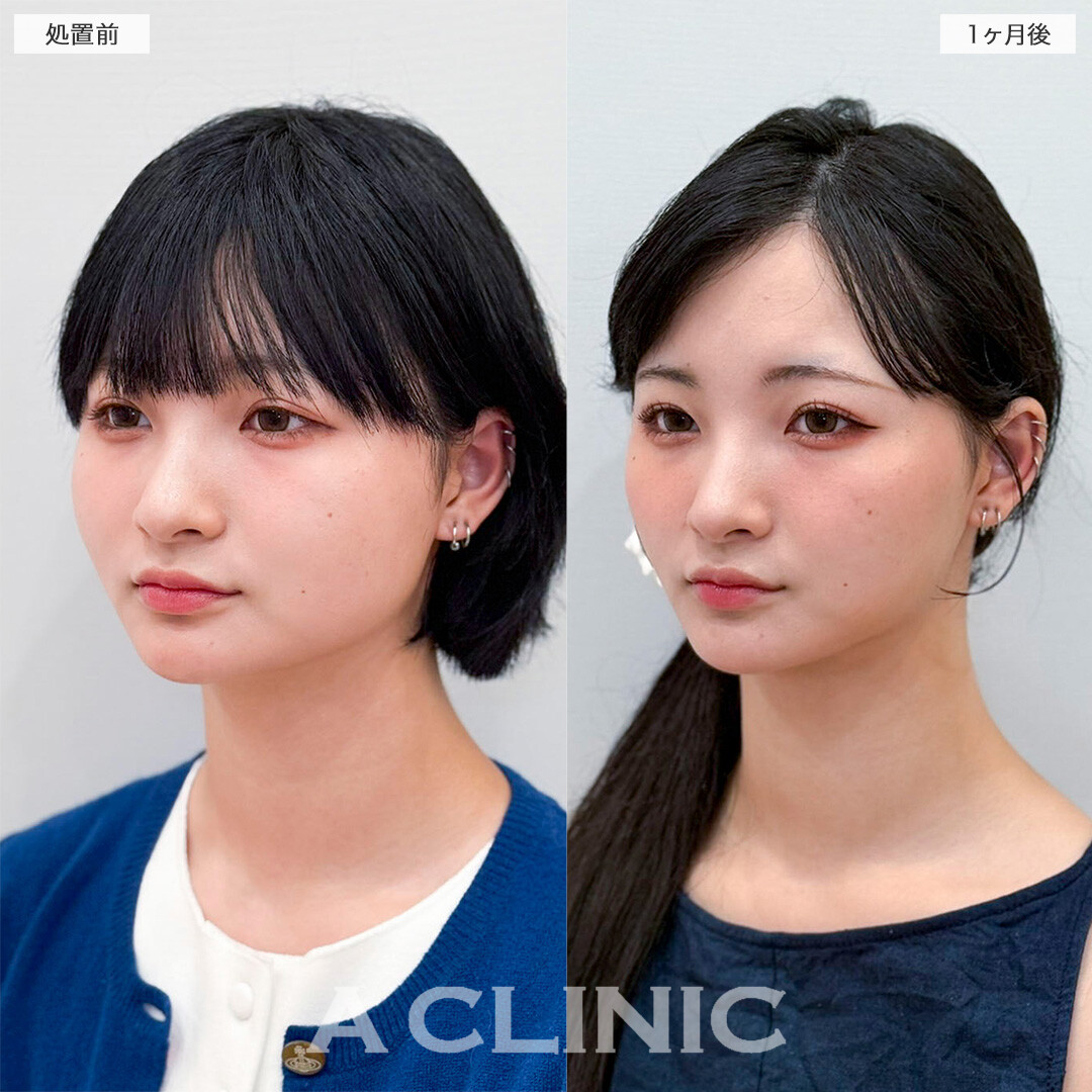1day小顔脂肪吸引で周りから小顔をさらに褒められるようになりました！処置前と2ヶ月後の症例です(20代女性)