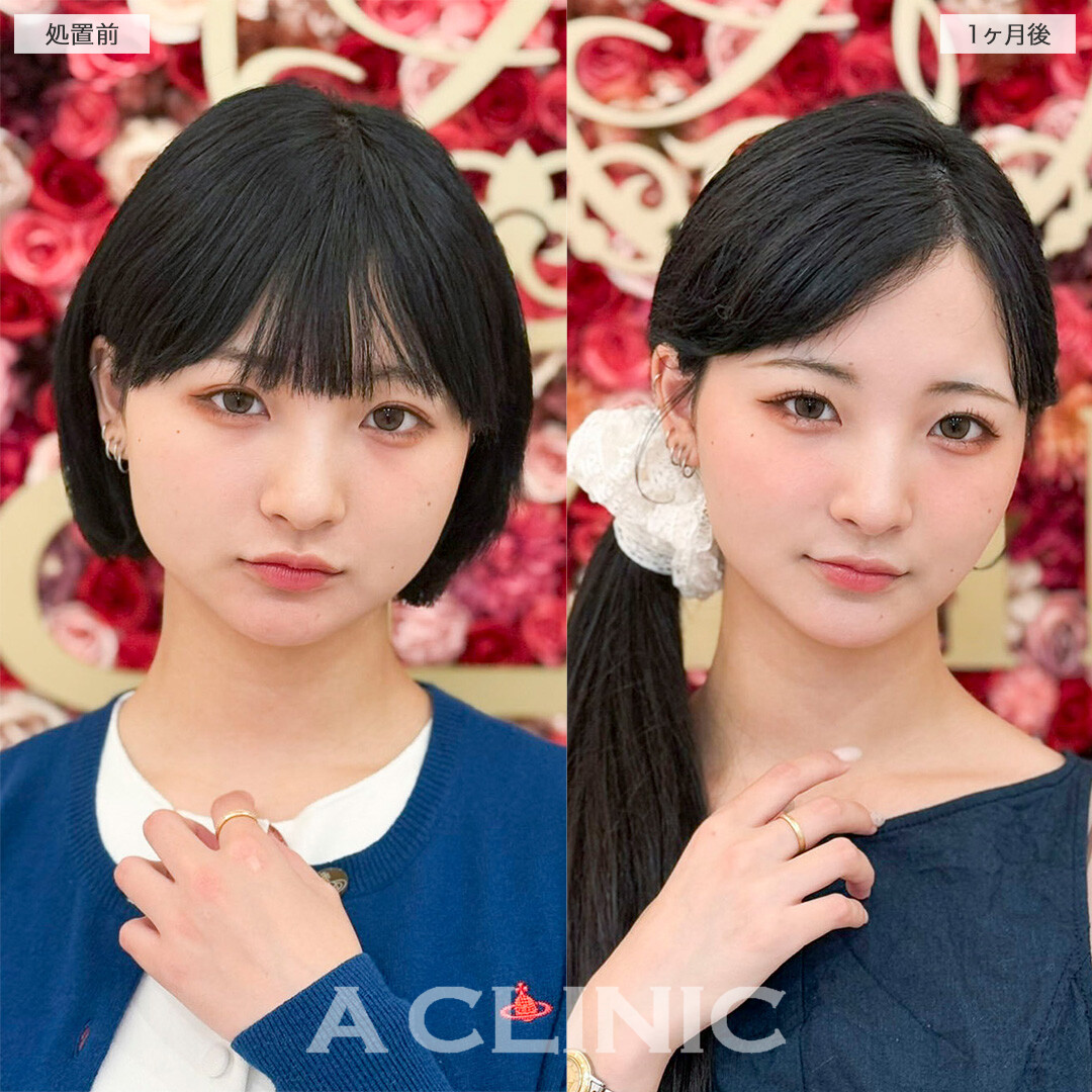 1day小顔脂肪吸引で周りから小顔をさらに褒められるようになりました！処置前と2ヶ月後の症例です(20代女性)