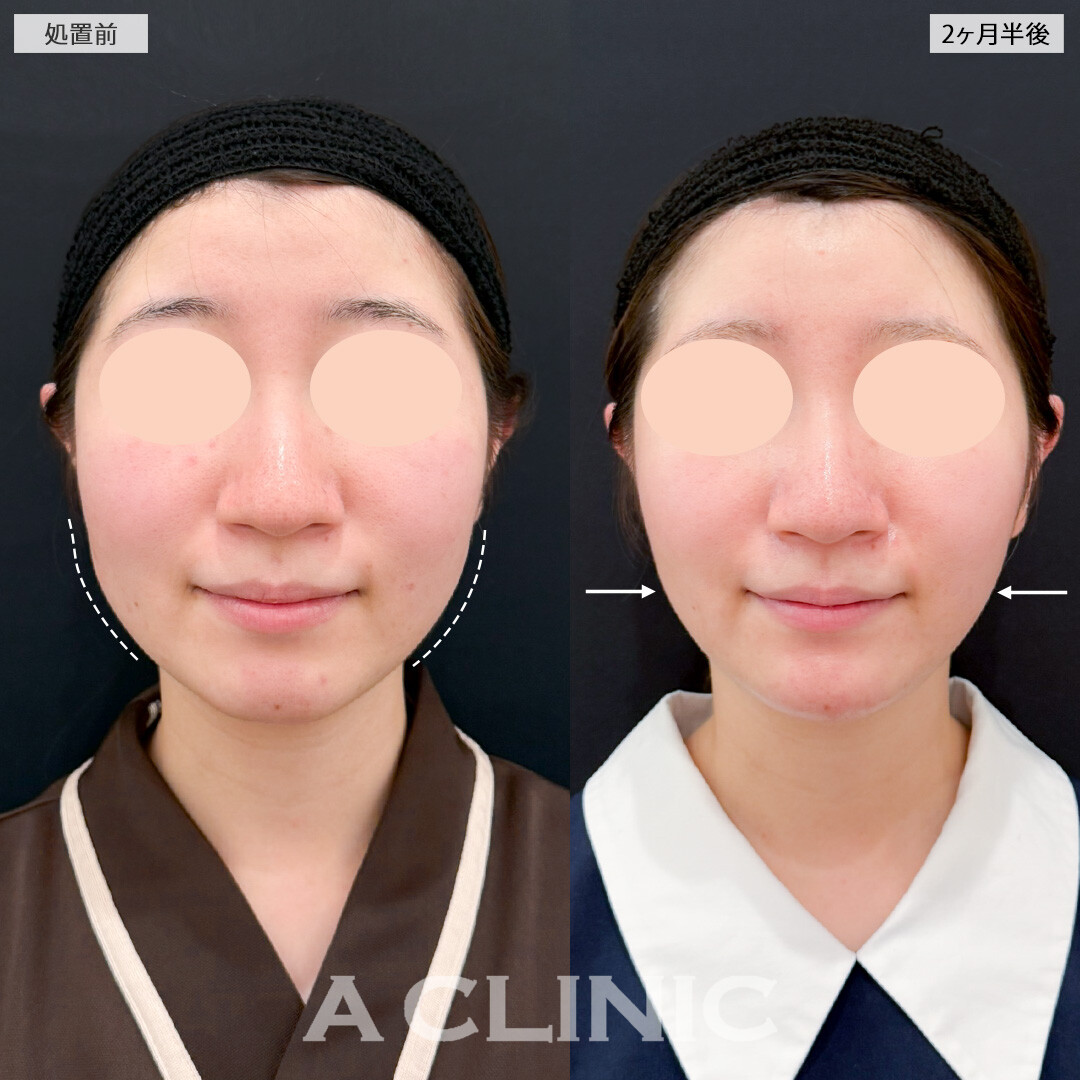 1day小顔脂肪吸引とあごへのヒアルロン酸注入で自分に合った輪郭形成で顔の印象をがらりと変化！処置前と2ヶ月半後の症例です(20代女性)