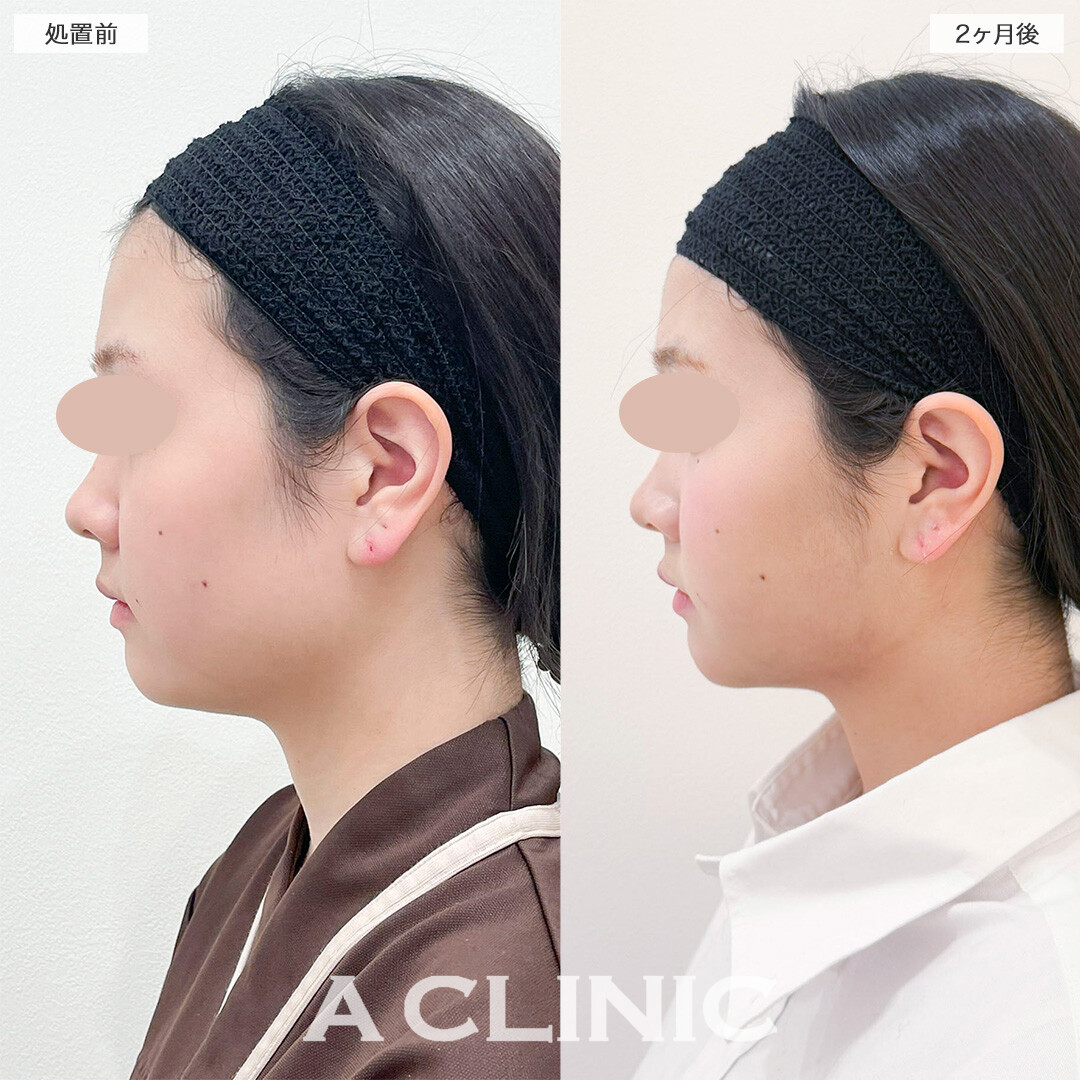 1day小顔脂肪吸引で理想の卵型の輪郭になりました！処置前と2ヶ月後の症例です(10代女性)