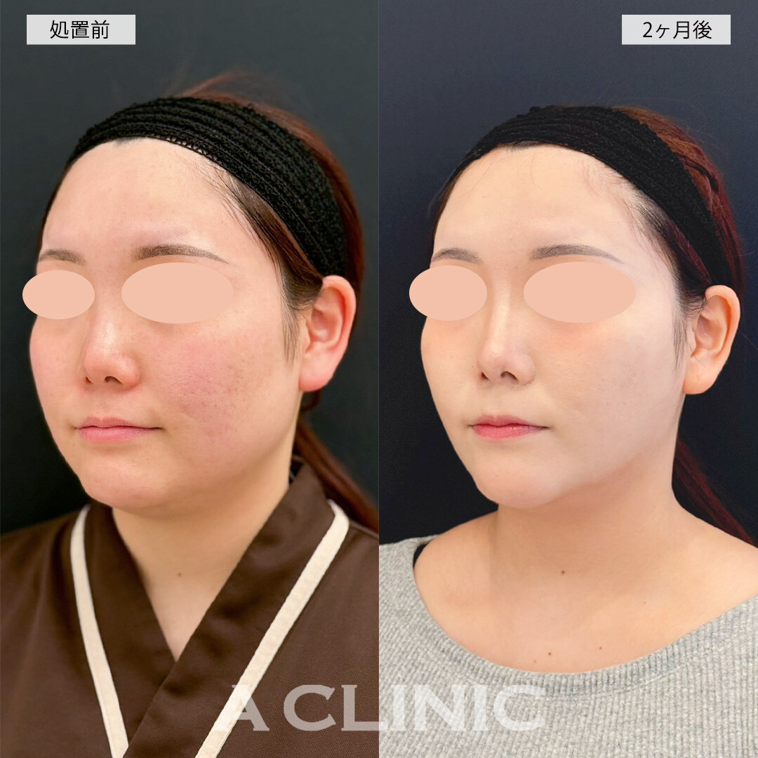 1day小顔脂肪吸引で－10kg痩せたかのような印象に！こちら処置前と2ヶ月後の症例です(20代女性)