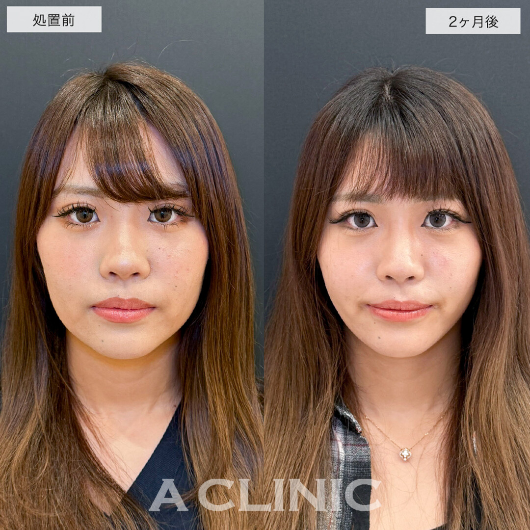 1day小顔脂肪吸引で確かな変化を感じる小顔に!こちら処置前と2ヶ月後の症例です(20代女性)