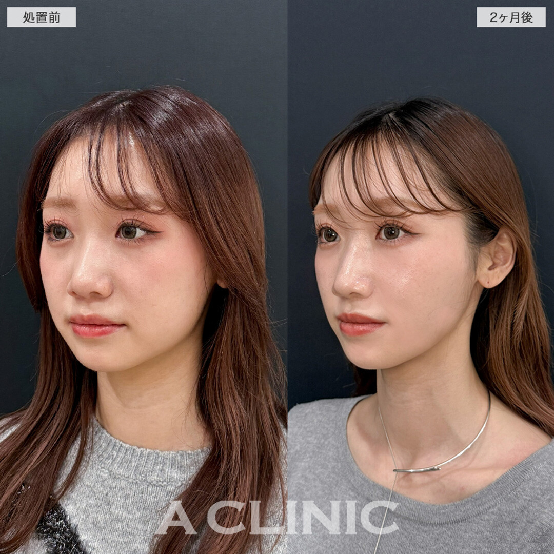 1day小顔脂肪吸引で口横のもたつきをスッキリ解消！こちら処置前と2ヶ月後の症例です(20代女性)