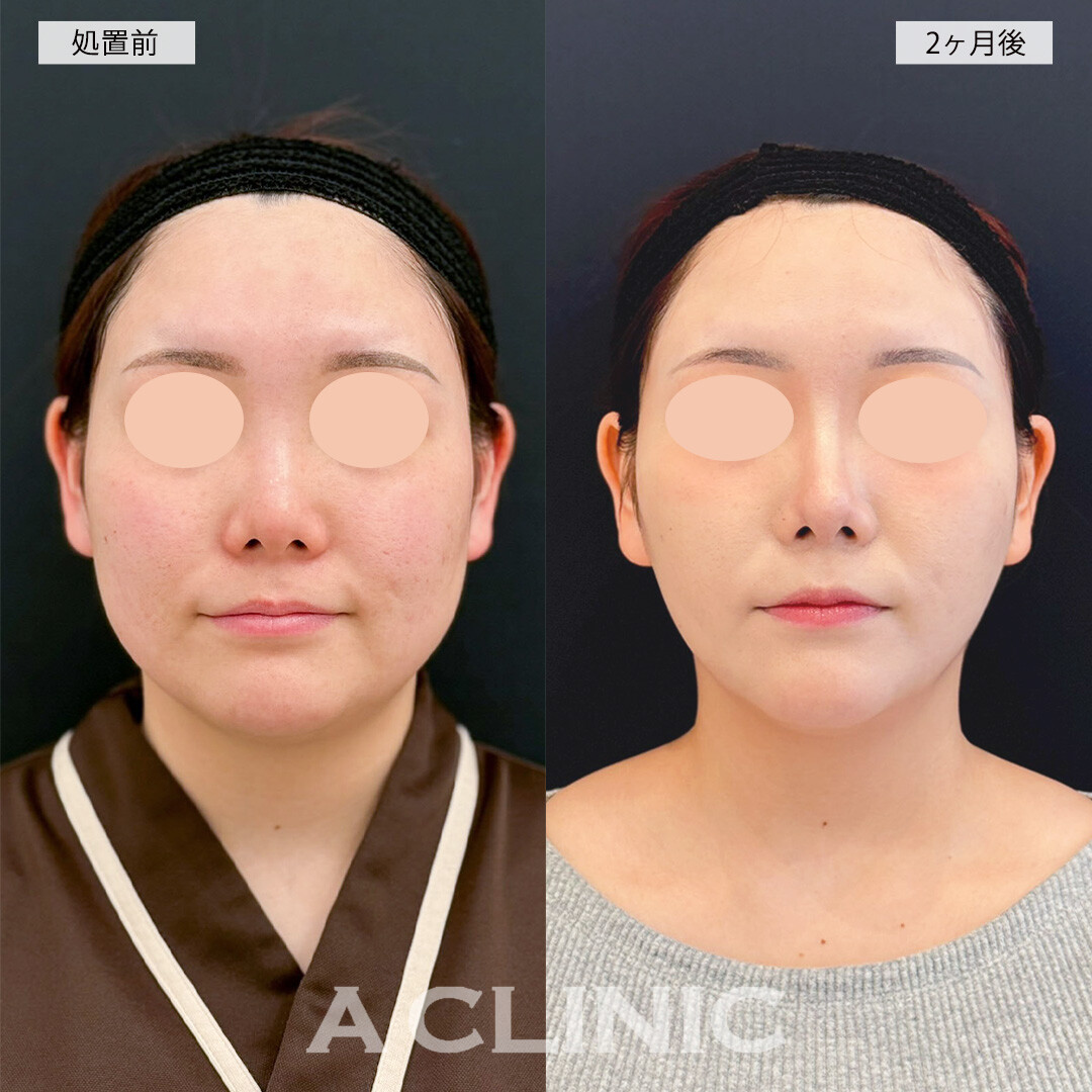 1day小顔脂肪吸引で－10kg痩せたかのような印象に！こちら処置前と2ヶ月後の症例です(20代女性)