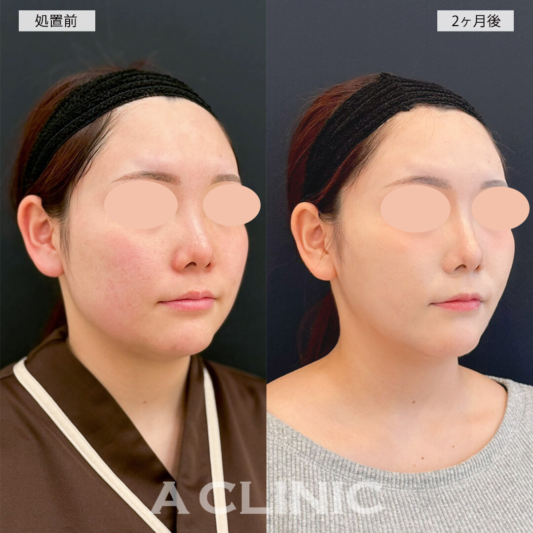 1day小顔脂肪吸引で－10kg痩せたかのような印象に！こちら処置前と2ヶ月後の症例です(20代女性)