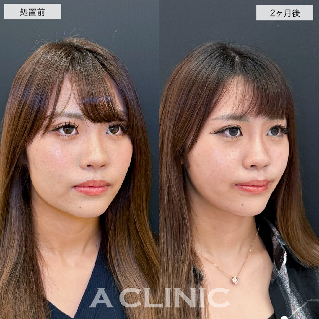1day小顔脂肪吸引で確かな変化を感じる小顔に!こちら処置前と2ヶ月後の症例です(20代女性)