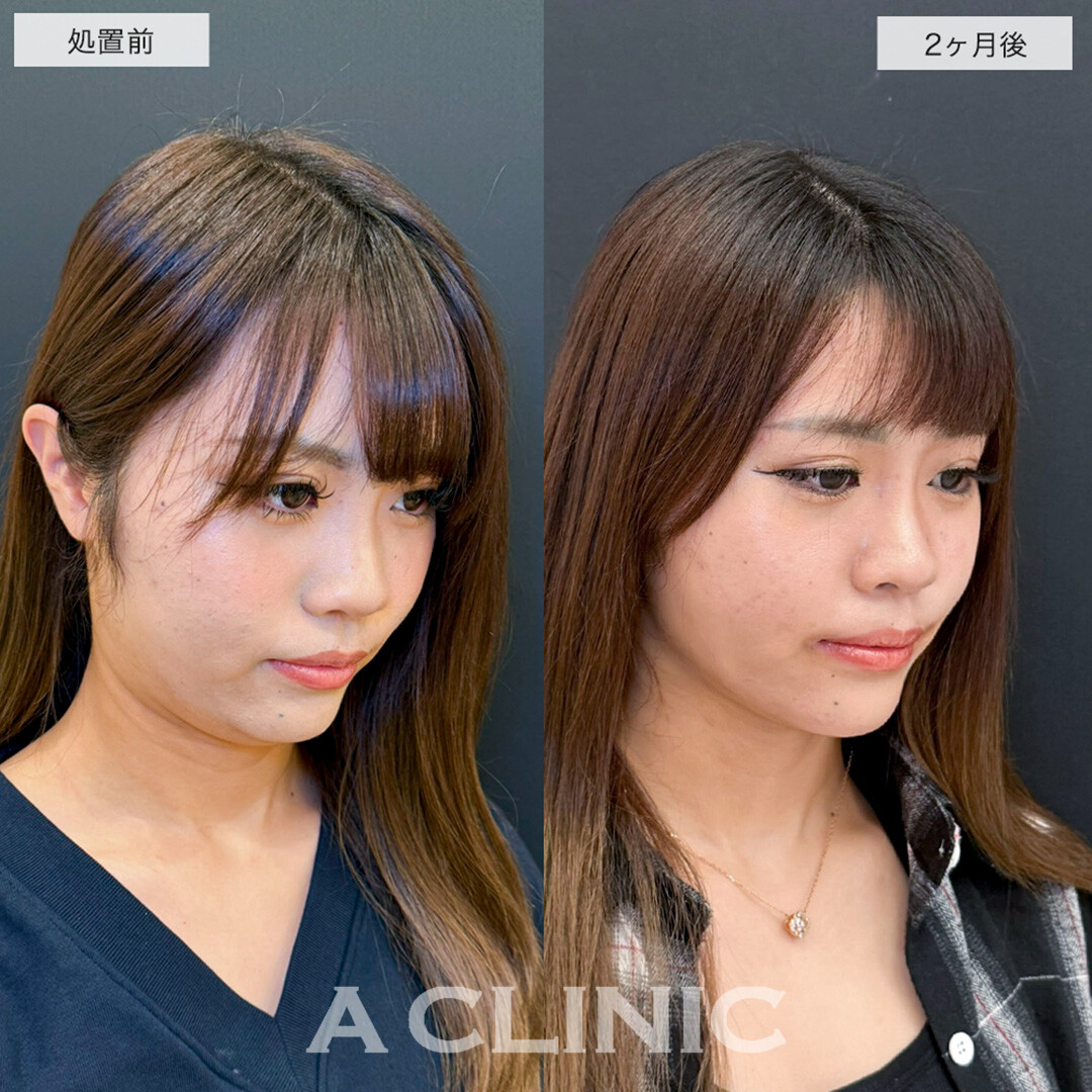 1day小顔脂肪吸引で確かな変化を感じる小顔に!こちら処置前と2ヶ月後の症例です(20代女性)