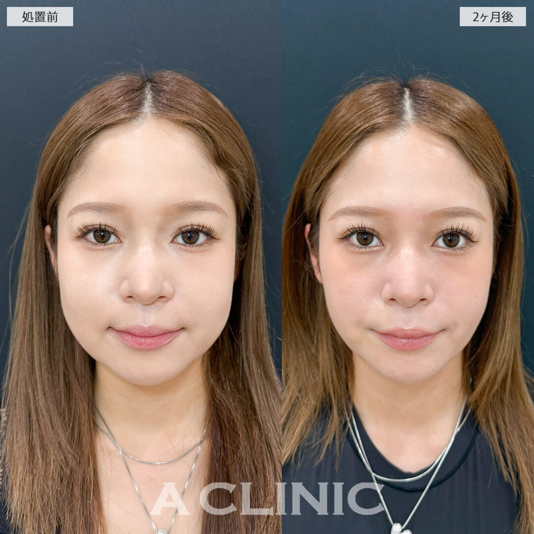 1day小顔脂肪吸引と小顔エラボトックスでお顔全体の余白や口横のもたつきがなくなりスッキリとした輪郭になりました！処置前と2ヶ月後の症例です(20代女性)