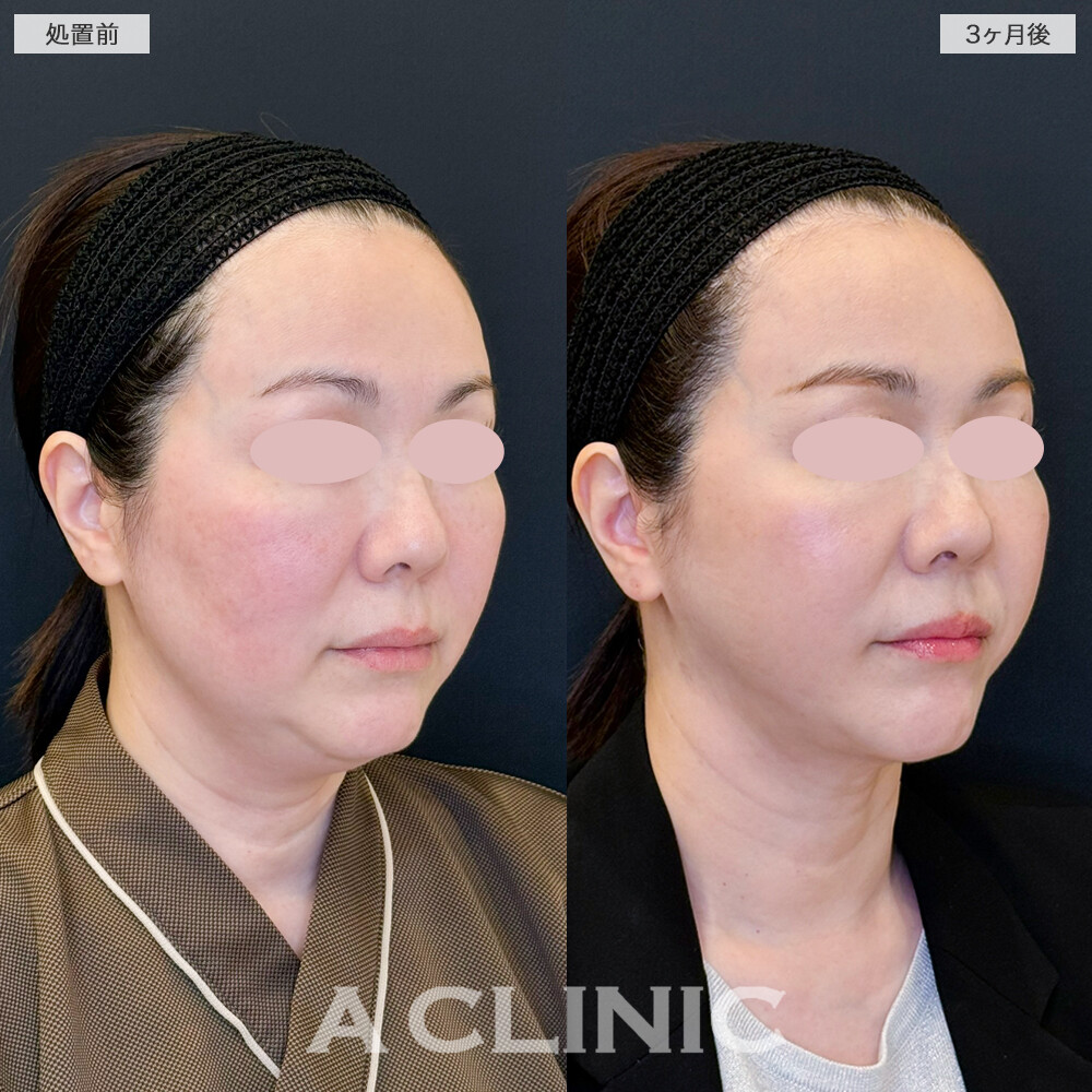 1day小顔脂肪吸引と小顔エラボトックスでもたつきやすいフェイスラインとあご下がすっきり。処置前と3ヶ月後の症例です(50代女性)