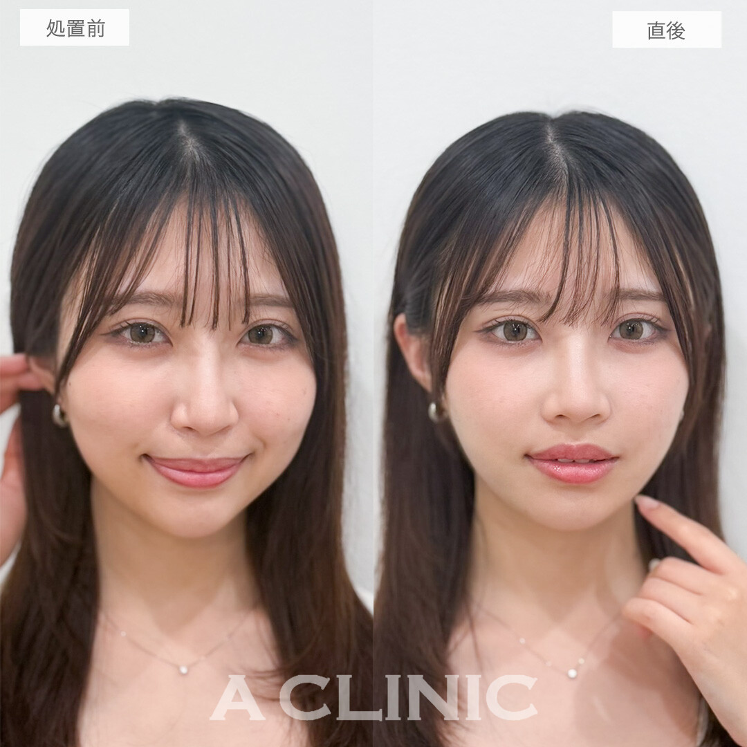 1day小顔脂肪吸引で術直後とは思えないほど綺麗な仕上がりに！処置前と直後の症例です(20代女性)