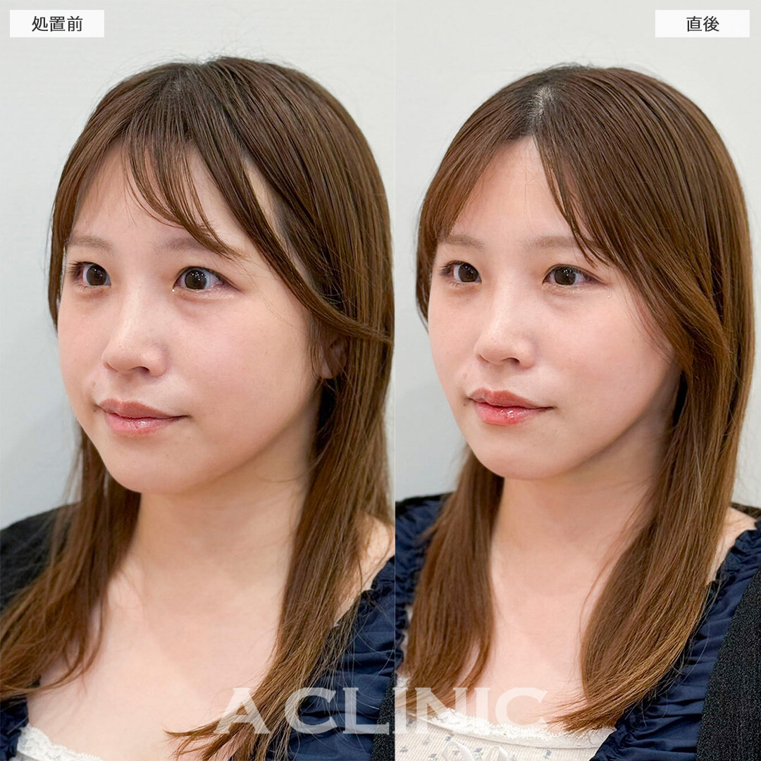 1day小顔脂肪吸引なら直後から腫れ最小限で予定も入れられます！処置前と直後の症例です(30代女性)
