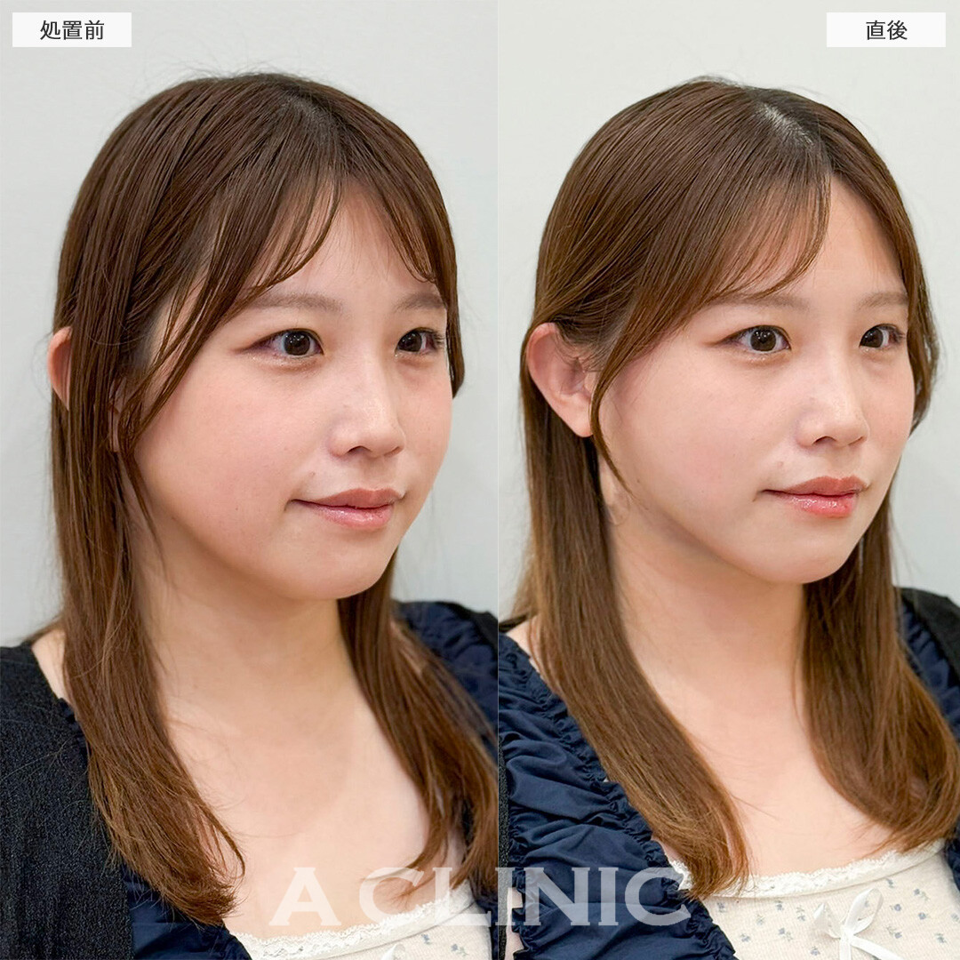 1day小顔脂肪吸引なら直後から腫れ最小限で予定も入れられます！処置前と直後の症例です(30代女性)