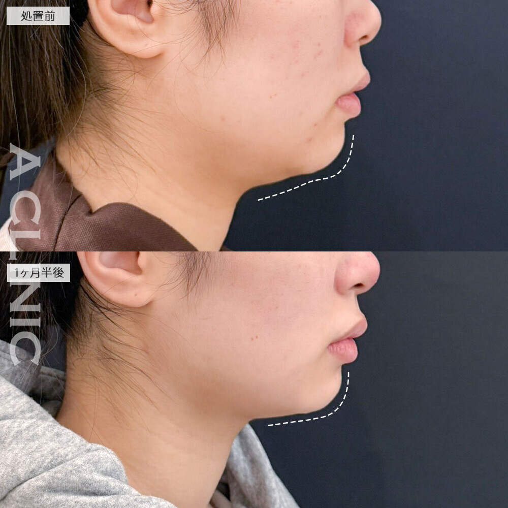 1day小顔脂肪吸引と小顔エラボトックスで面長解消！こちら処置前と1ヶ月半後の症例です(20代女性)