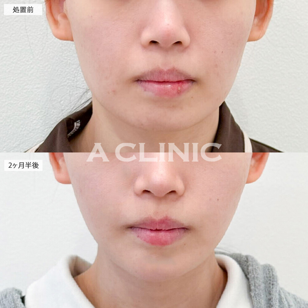 1day小顔脂肪吸引と小顔エラボトックスとあごへのヒアルロン酸注入できゅっと引き締まりより小顔に！こちら処置前と2ヶ月半後の症例です(20代女性)