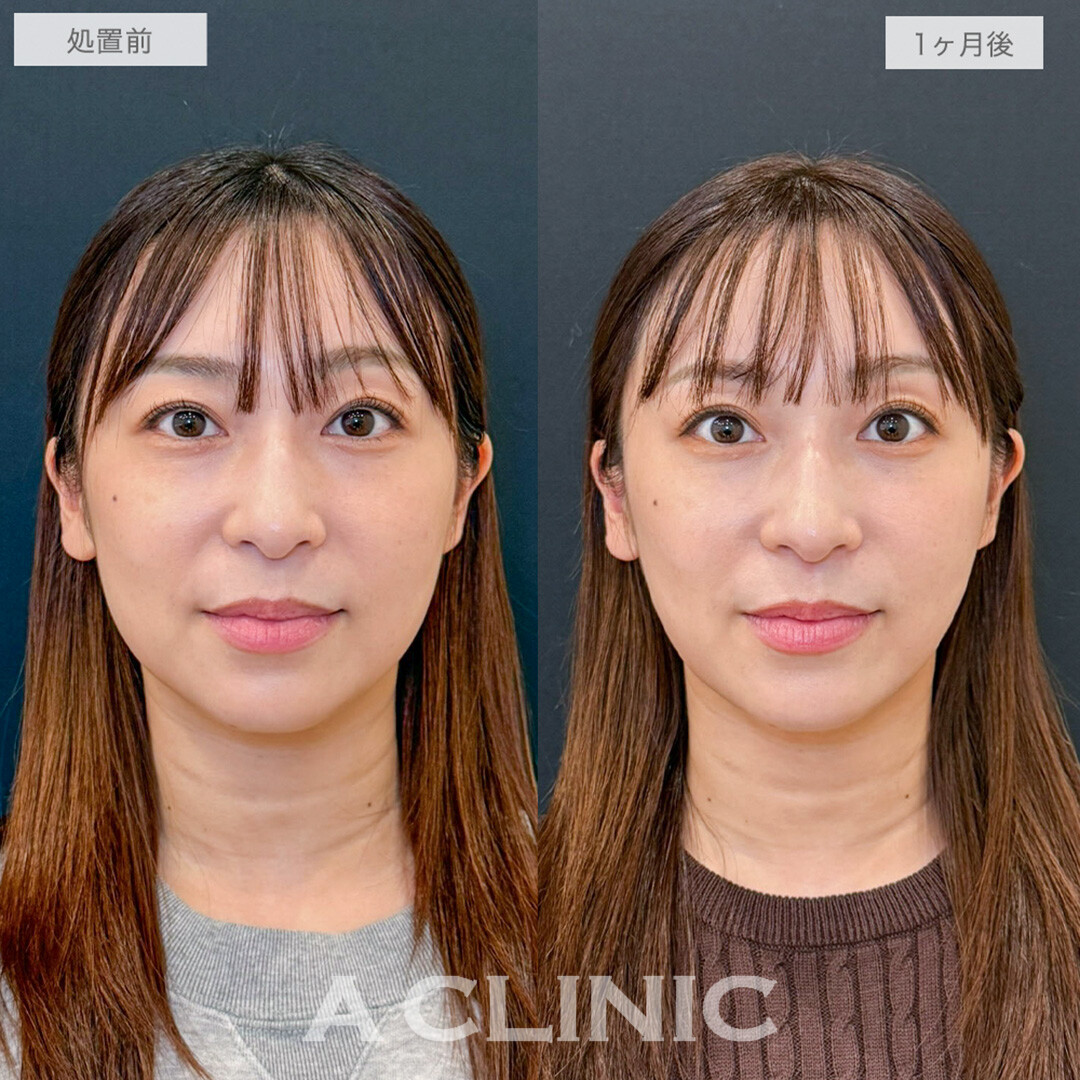 1day小顔脂肪吸引で口横とフェイスラインのたるみがスッキリ解消されました！処置前と1ヶ月後の症例です(30代女性)