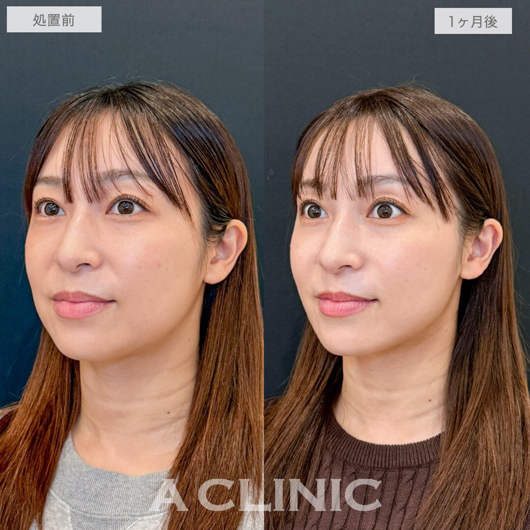 1day小顔脂肪吸引で口横とフェイスラインのたるみがスッキリ解消されました！処置前と1ヶ月後の症例です(30代女性)