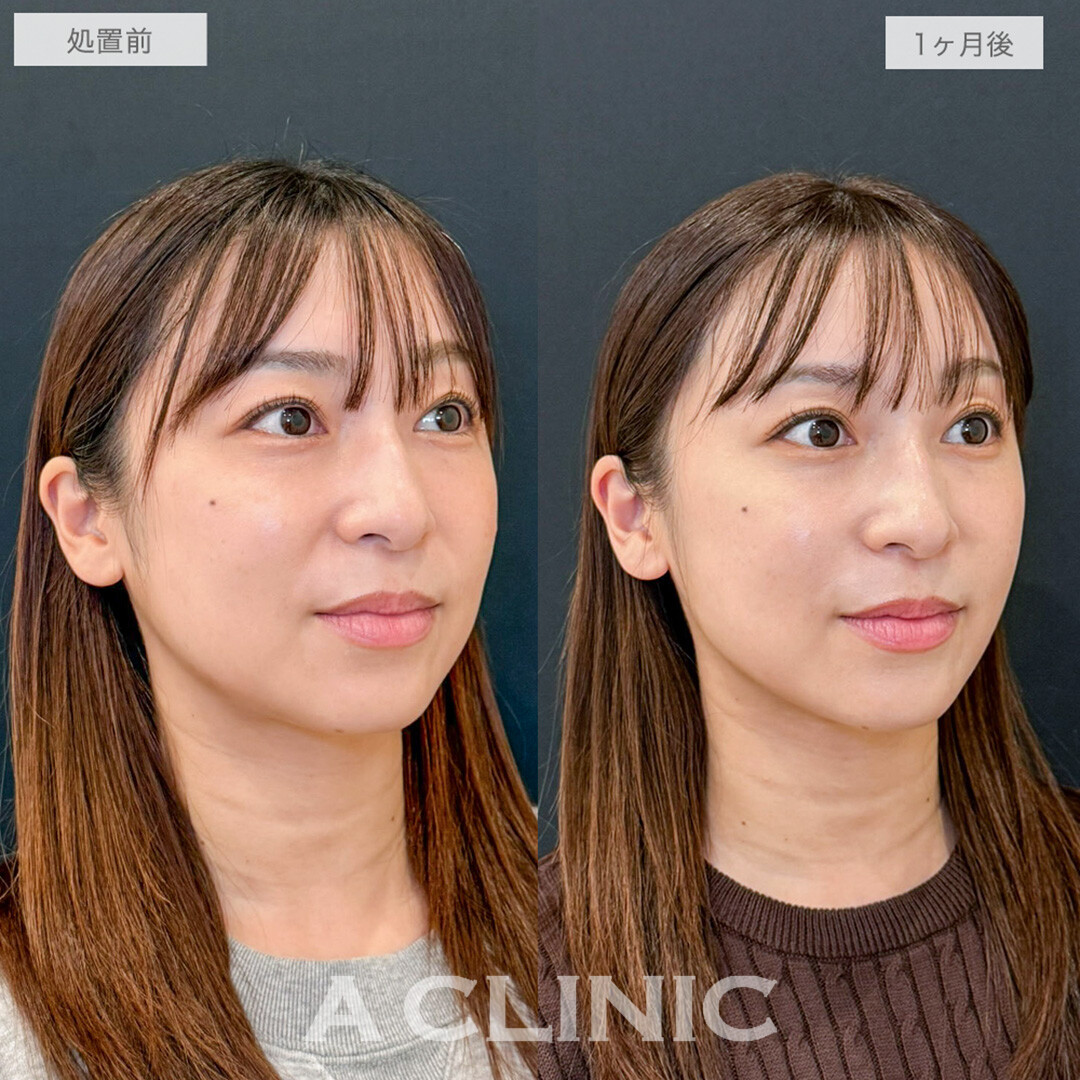 1day小顔脂肪吸引で口横とフェイスラインのたるみがスッキリ解消されました！処置前と1ヶ月後の症例です(30代女性)