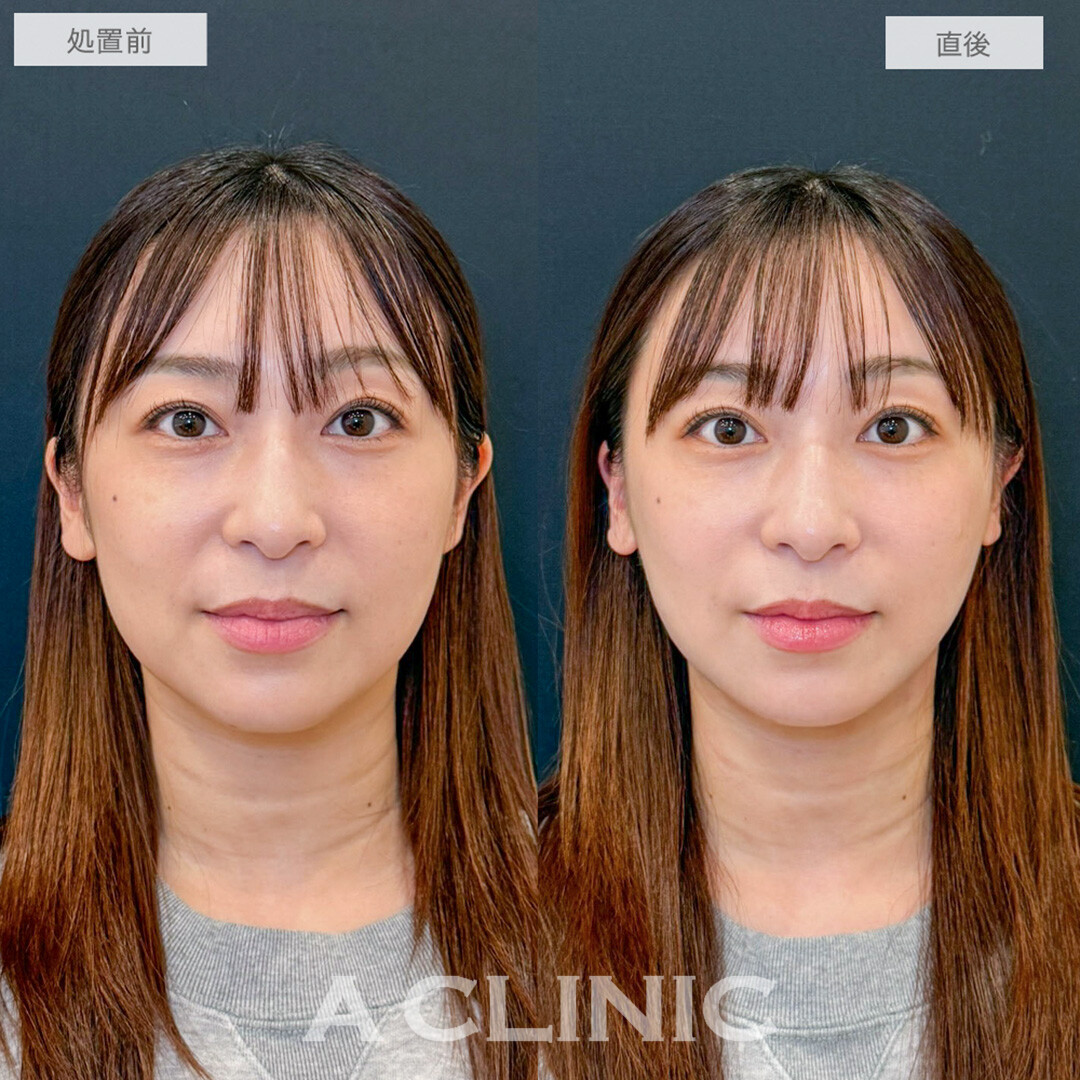 1day小顔脂肪吸引で直後からほうれい線もなくなり若々しい印象に！処置前と直後の症例です(30代女性)